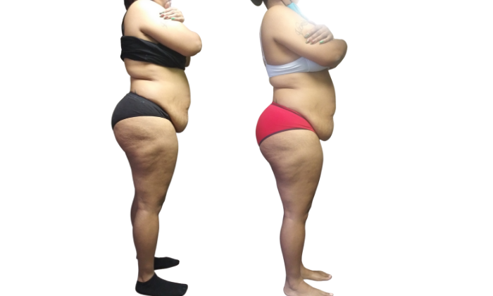 Smart Lipo 360