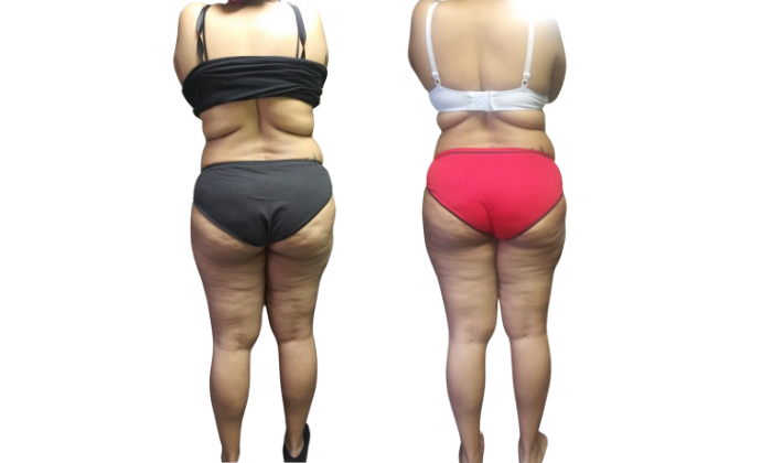 Smart Lipo 360