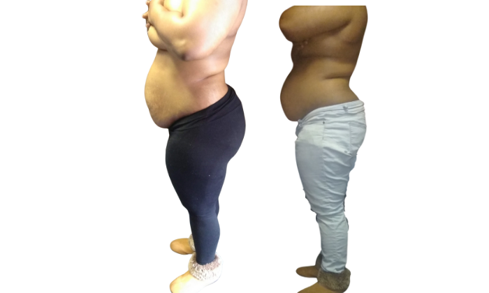 Mommy Makeover