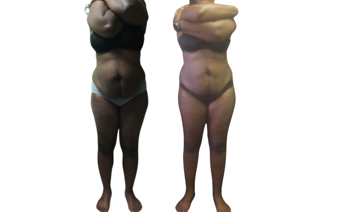 Mommy Makeover