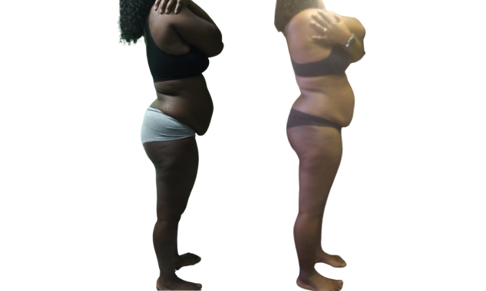 Mommy Makeover