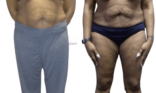 Skin Tightening