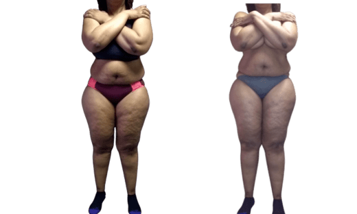 Mommy Makeover