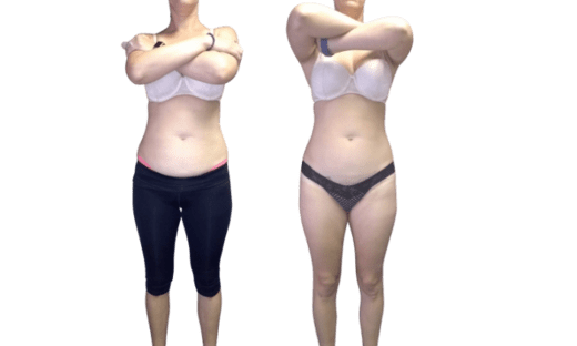 Smart Lipo