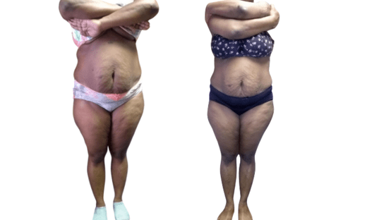 Mommy Makeover