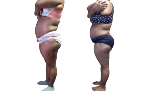 Mommy Makeover