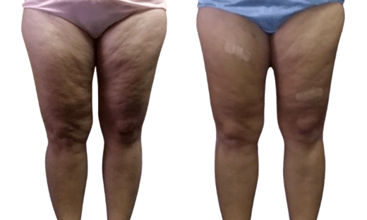 Cellulite Reduction