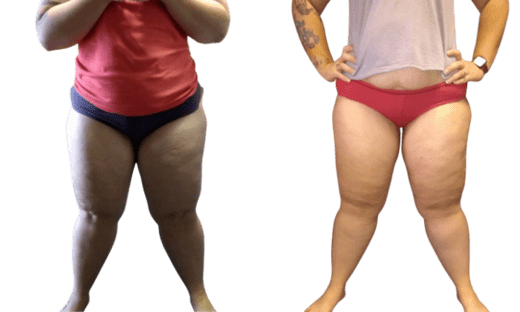 Smart Lipo