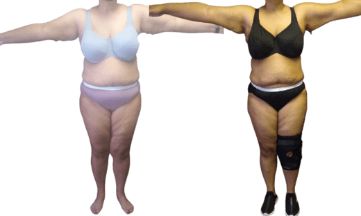 Mommy Makeover