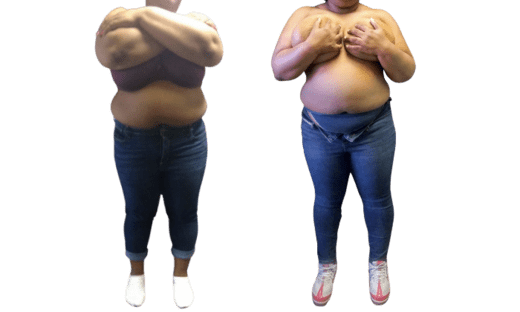 Mommy Makeover
