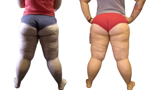 Smart Lipo